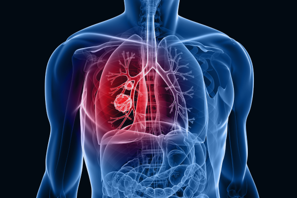 Discovery of Genes Associated with Lung Adenocarcinoma